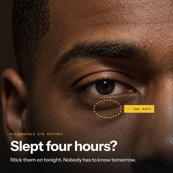 Close-up of a puffy under-eye area before using Ice — slept four hours?