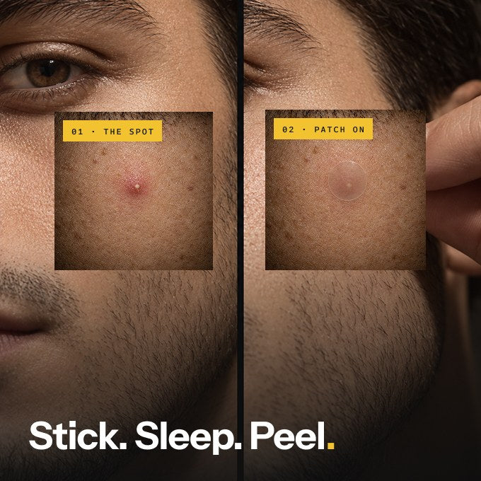 Before and after: a spot on a man's cheek, then the same spot covered by a clear Tape patch — Stick. Sleep. Peel.